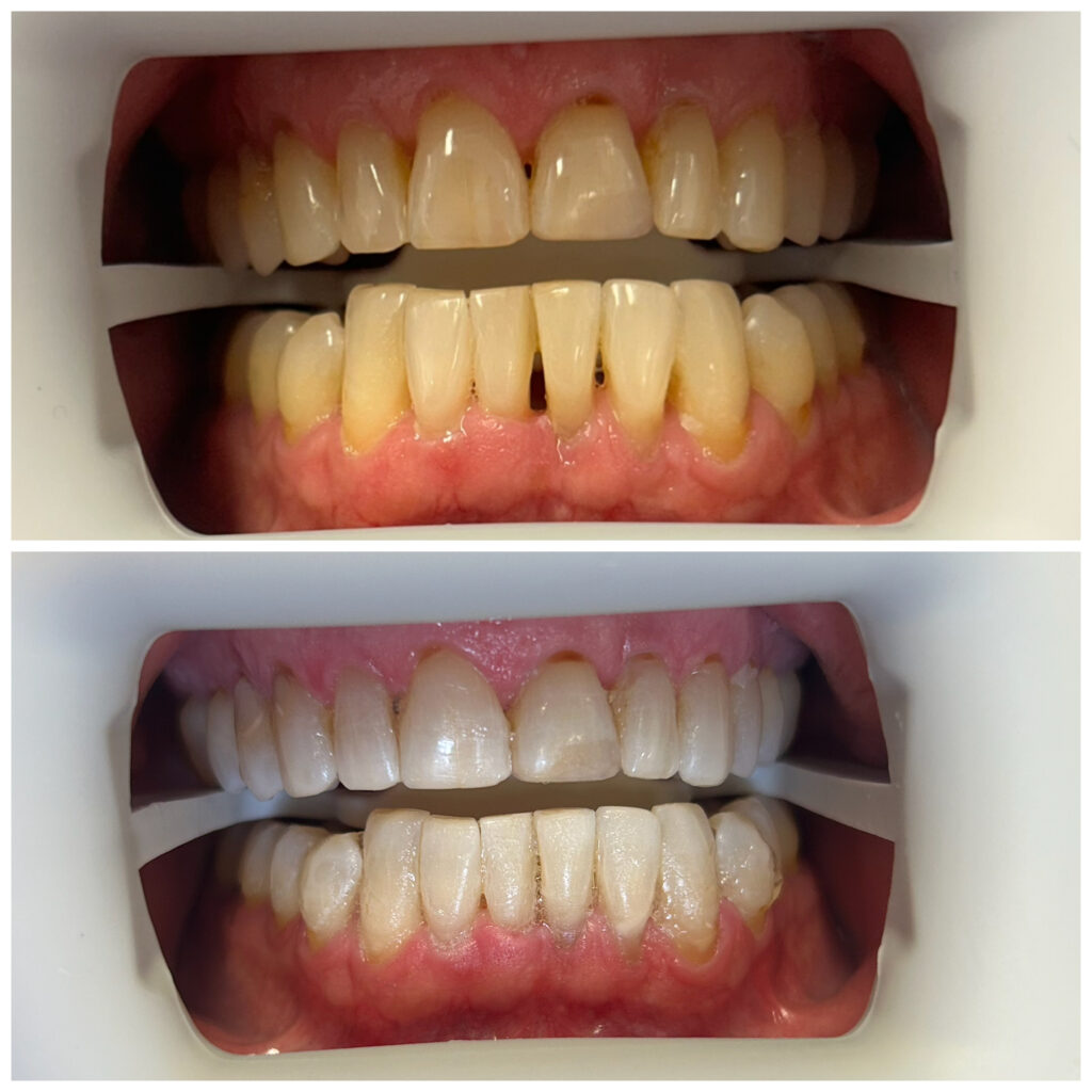 Premium in chair teeth whitening treatment