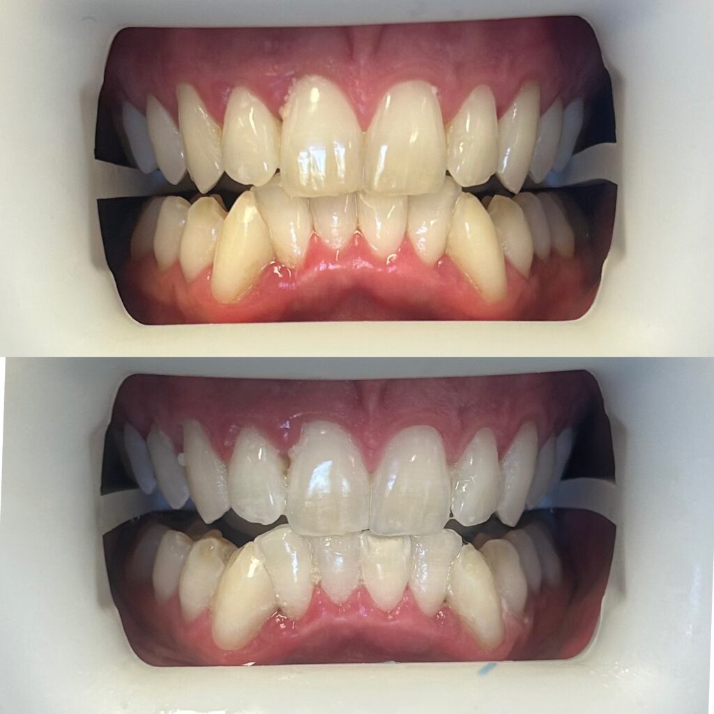 Premium in chair teeth whitening, Brisbane