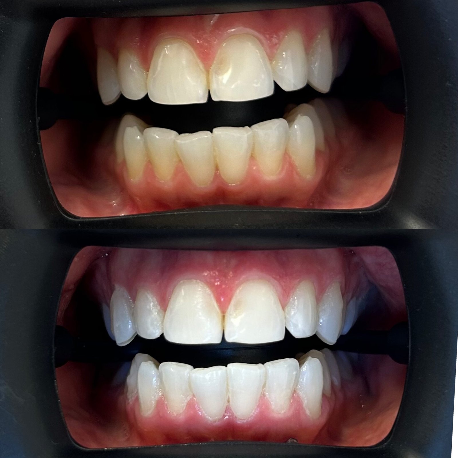 Before and after professional teeth whitening treatment in North Lakes Brisbane