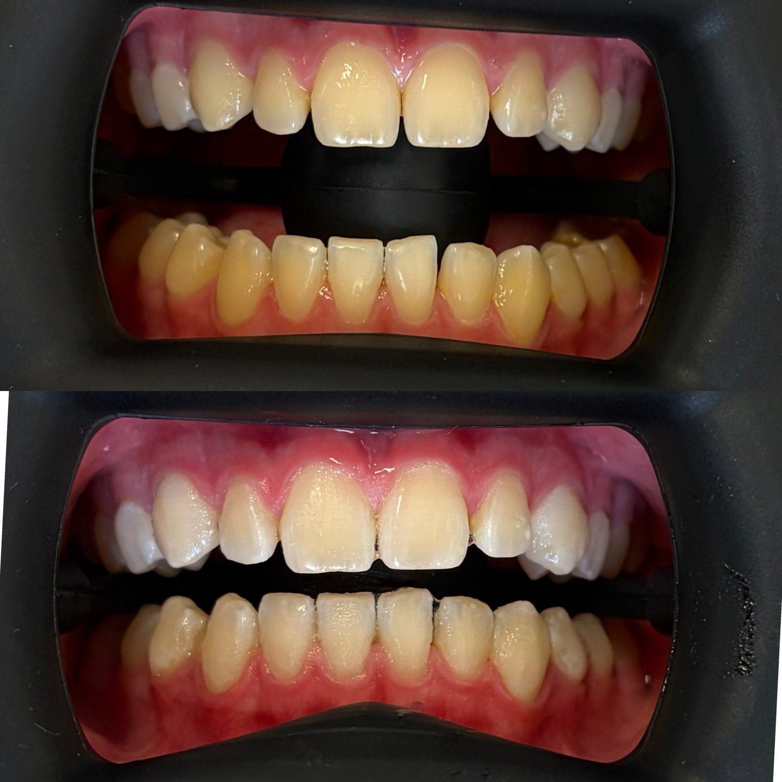 Before and after professional teeth whitening treatment in North Lakes Brisbane