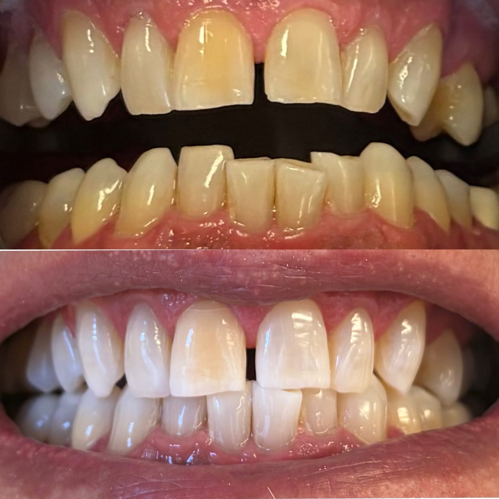 Before and after professional teeth whitening treatment in North Lakes Brisbane