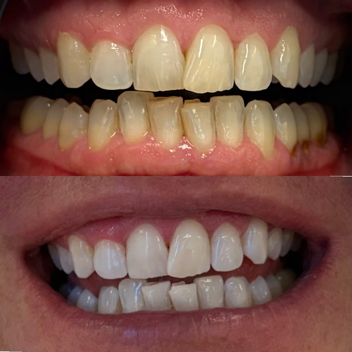 Before and after professional teeth whitening treatment in North Lakes Brisbane