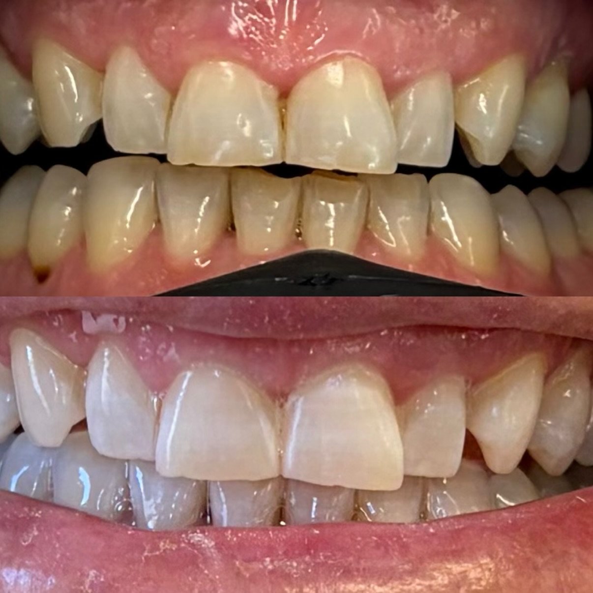 in chair teeth whitening north lakes brisbane