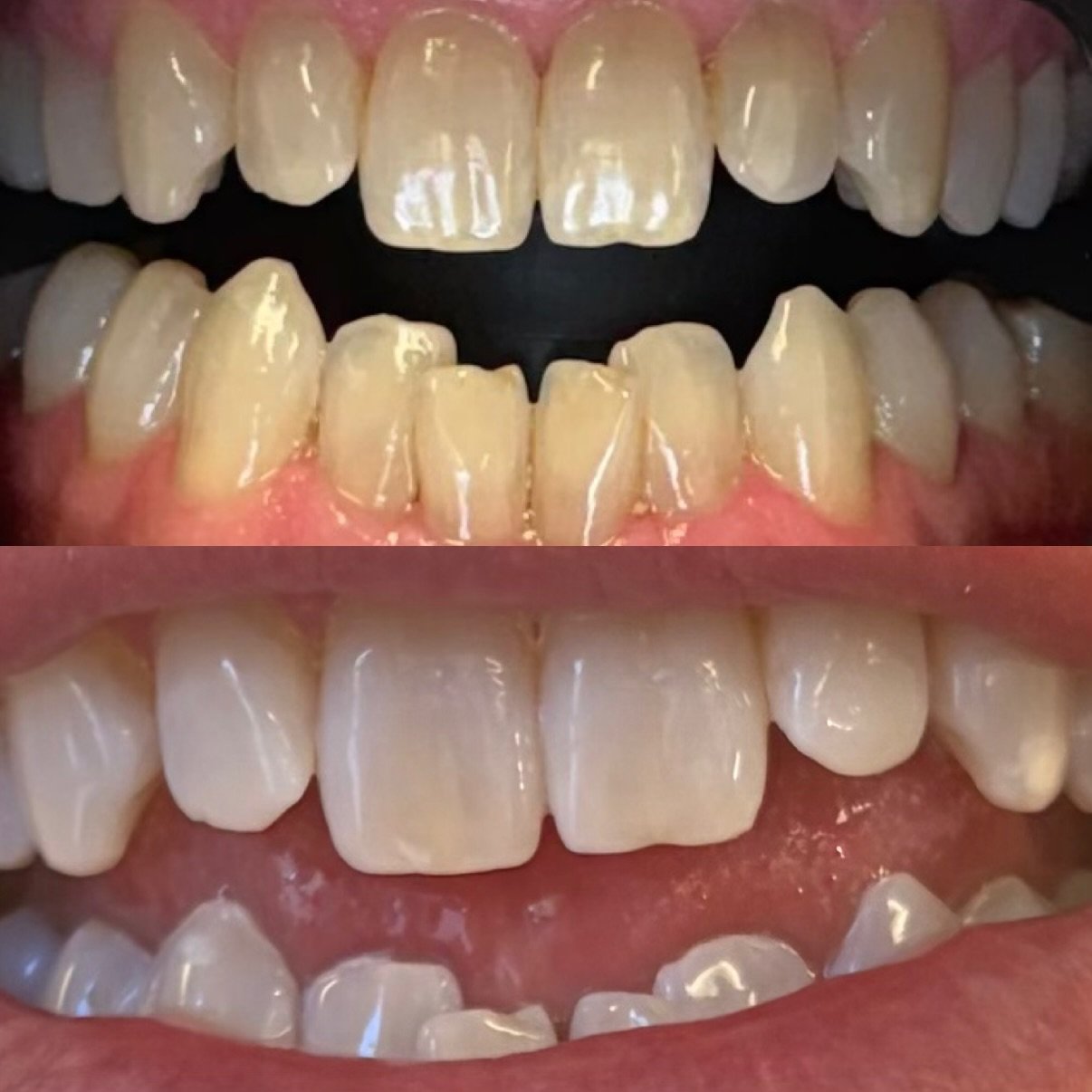 in chair teeth whitening north lakes brisbane