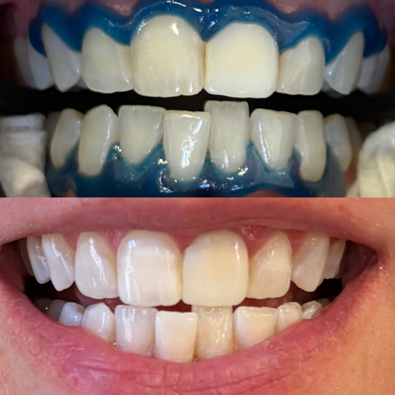 In Chair teeth whitening north lakes brisbane