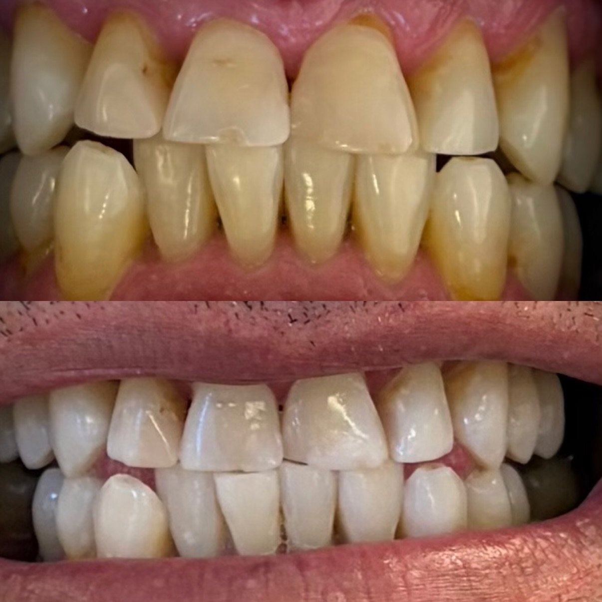 in chair teeth whitening north lakes brisbane
