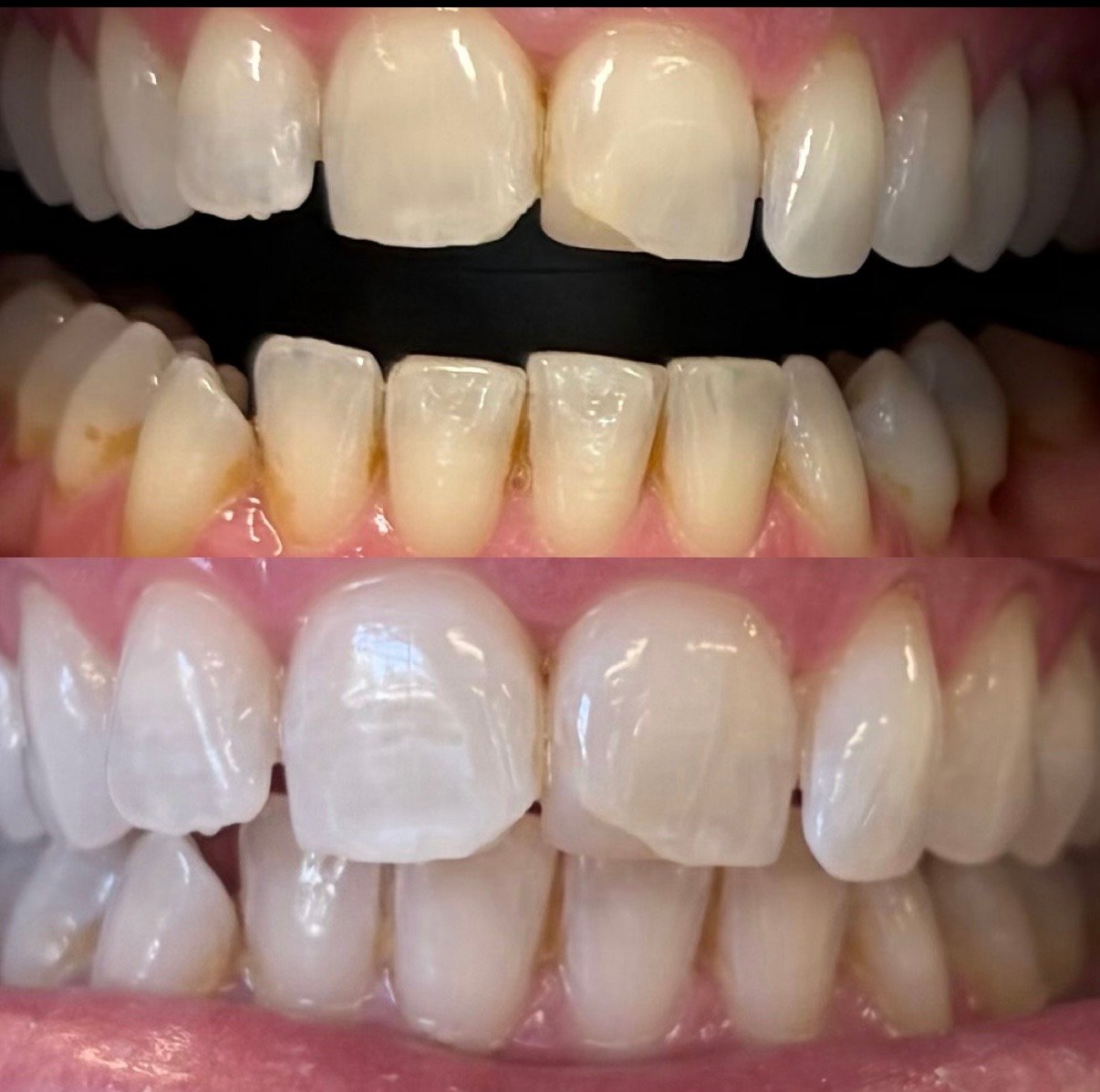 in chair teeth whitening north lakes brisbane