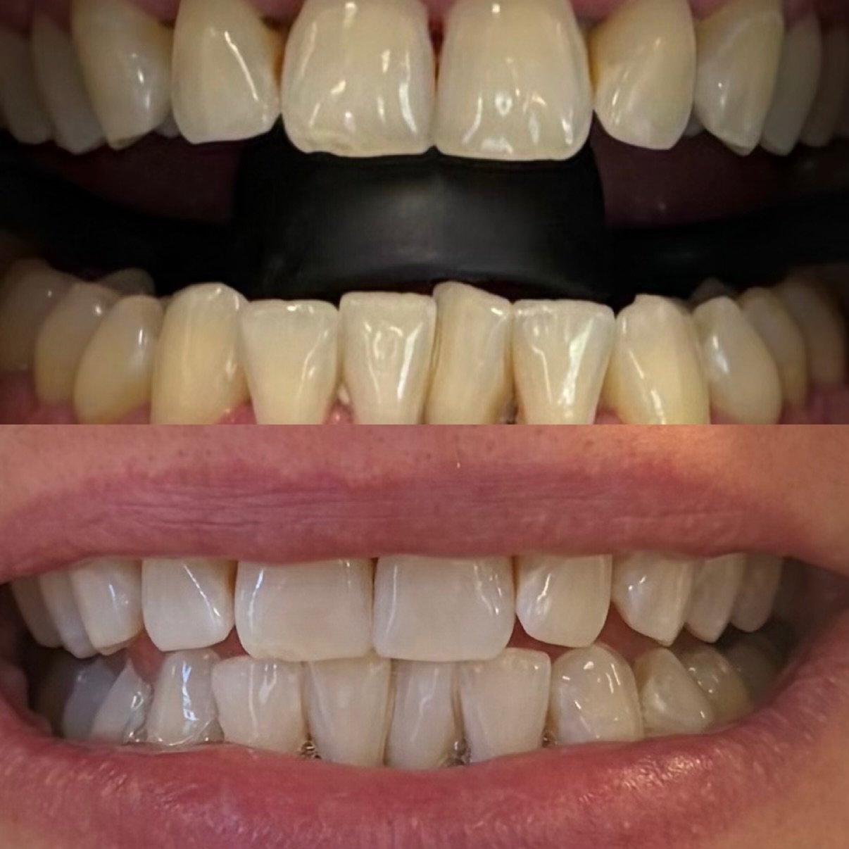 In Chair teeth whitening north lakes brisbane
